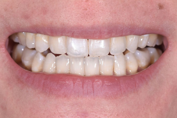 Dental Crowns and Bridges in Yorkville Toronto by Dr. Mario Rotella