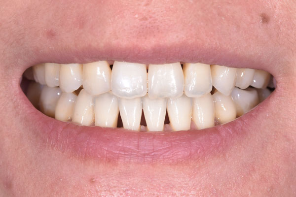 Dental Crowns and Bridges in Yorkville Toronto by Dr. Mario Rotella