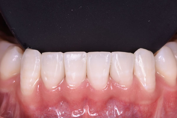 Dental Crowns and Bridges in Yorkville Toronto by Dr. Mario Rotella