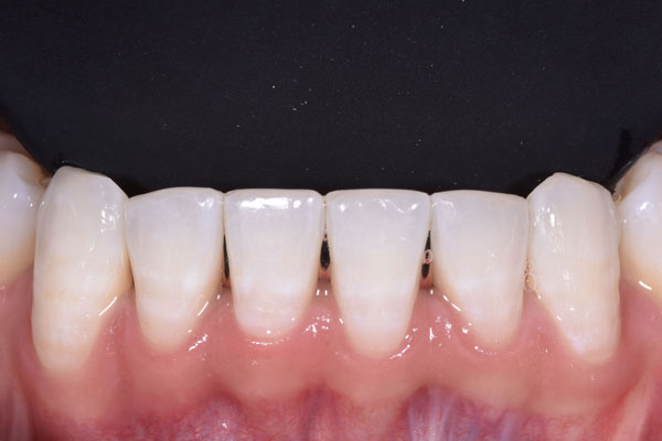 Dental Crowns and Bridges in Yorkville Toronto by Dr. Mario Rotella