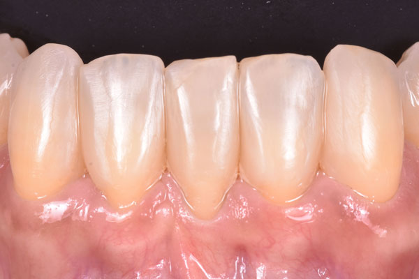 Dental Crowns and Bridges in Yorkville Toronto by Dr. Mario Rotella