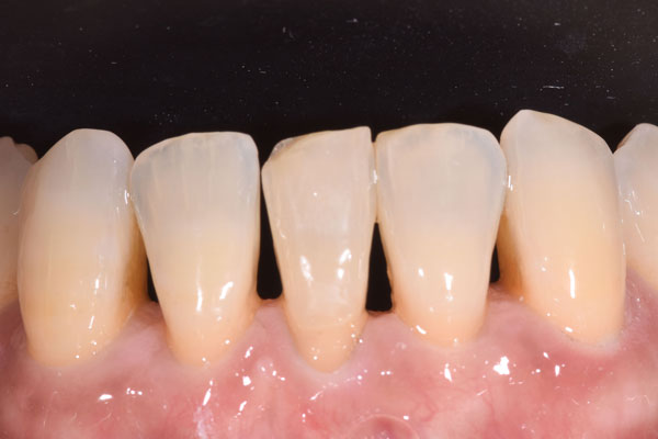 Dental Crowns and Bridges in Yorkville Toronto by Dr. Mario Rotella