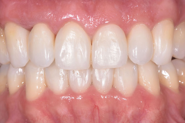 Dental Crowns and Bridges in Yorkville Toronto by Dr. Mario Rotella