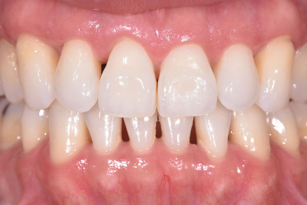 Dental Crowns and Bridges in Yorkville Toronto by Dr. Mario Rotella