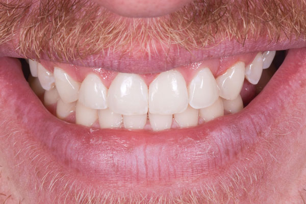 Dental Crowns and Bridges in Yorkville Toronto by Dr. Mario Rotella