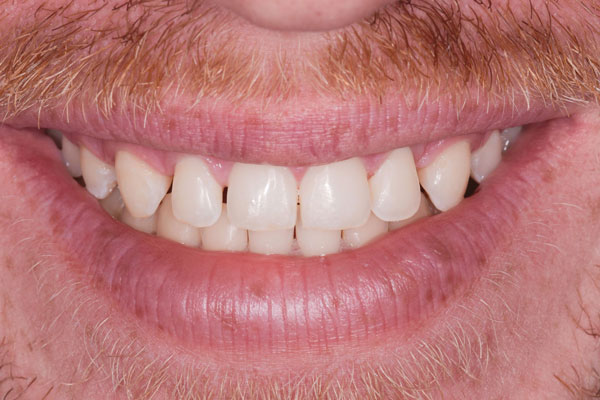 Dental Crowns and Bridges in Yorkville Toronto by Dr. Mario Rotella