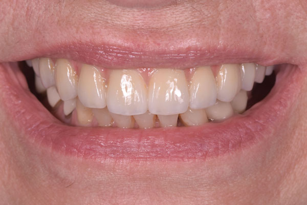 Dental Crowns and Bridges in Yorkville Toronto by Dr. Mario Rotella