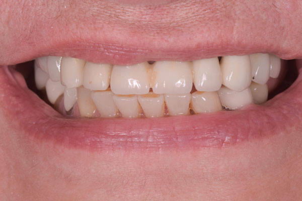 Dental Crowns and Bridges in Yorkville Toronto by Dr. Mario Rotella