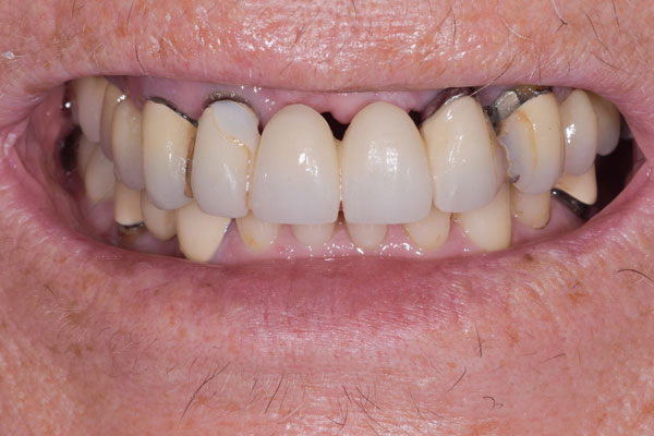 Dental Crowns and Bridges in Yorkville Toronto by Dr. Mario Rotella