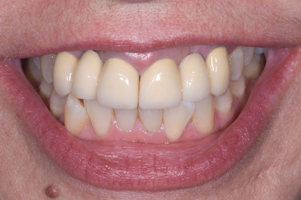 Dental Crowns and Bridges in Yorkville Toronto by Dr. Mario Rotella