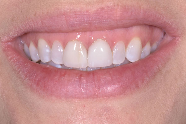 Dental Crowns and Bridges in Yorkville Toronto by Dr. Mario Rotella