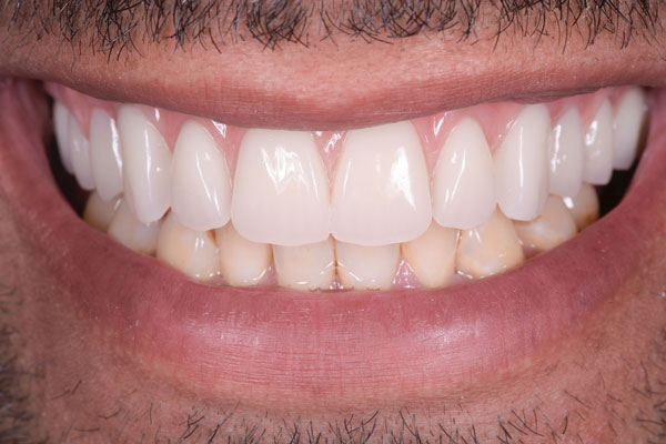 Dental Crowns and Bridges in Yorkville Toronto by Dr. Mario Rotella