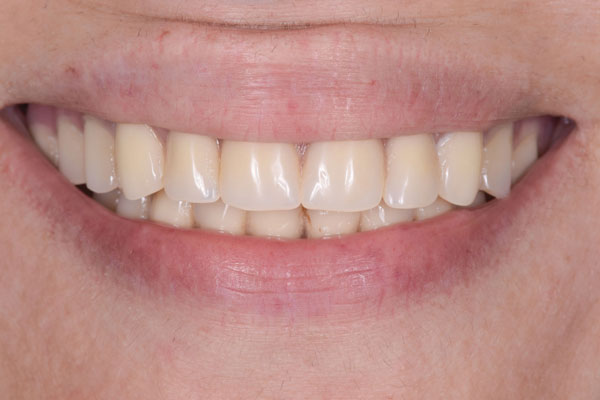 Dental Crowns and Bridges in Yorkville Toronto by Dr. Mario Rotella