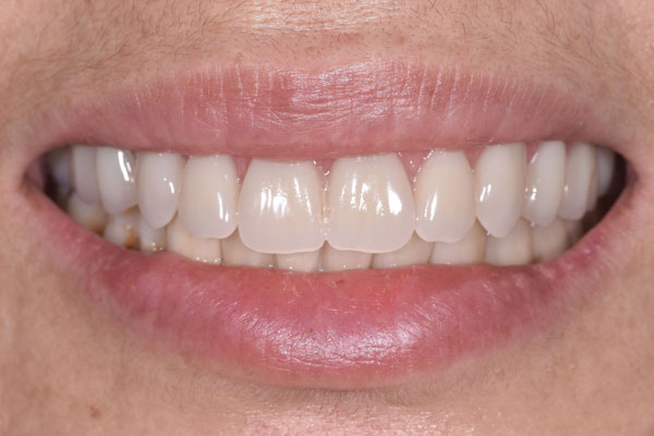 Dental Crowns and Bridges in Yorkville Toronto by Dr. Mario Rotella