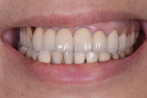 Dental Crowns and Bridges in Yorkville Toronto by Dr. Mario Rotella