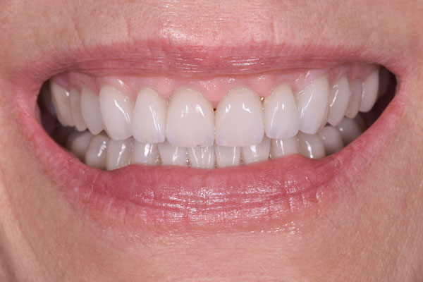 Dental Crowns and Bridges in Yorkville Toronto by Dr. Mario Rotella