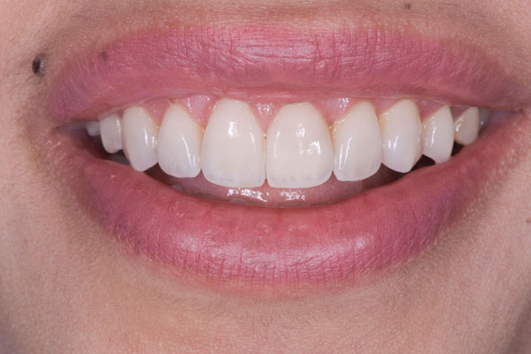 Dental Crowns and Bridges in Yorkville Toronto by Dr. Mario Rotella