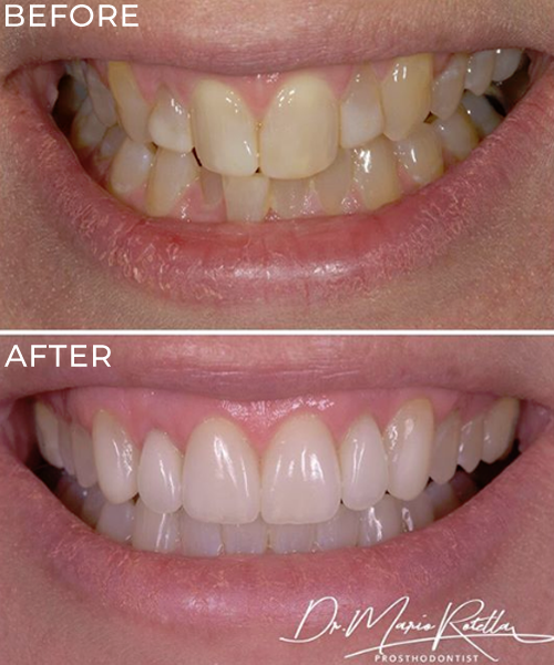 Porcelain Veneers Yorkville