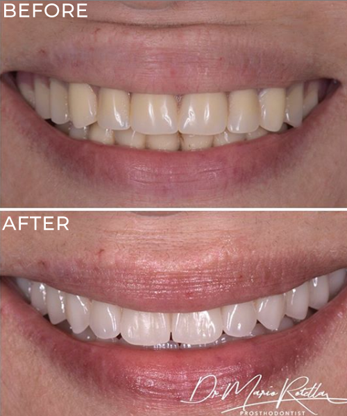 Smile Makeover Yorkville