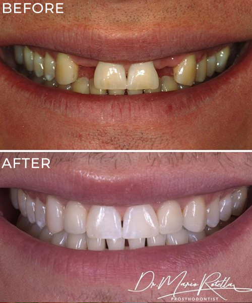 Dental Implants Yorkville